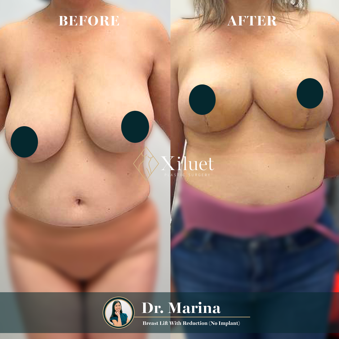¡Alerta de resultados asombrosos! Echa un vistazo a la impresionante transformación de nuestra hermosa paciente que se sometió a levantamiento de senos + reducción (sin implantes), expertamente realizado por la Dra. Marina Zorrilla.