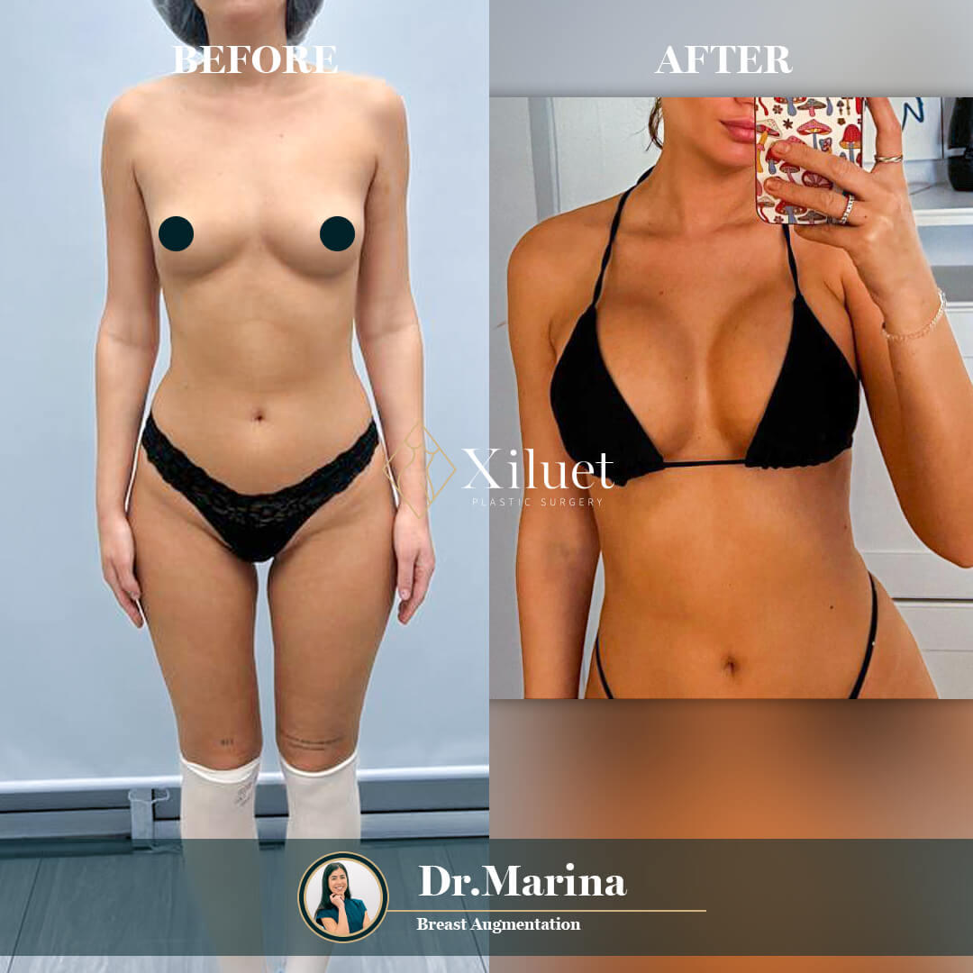 ¡Alerta de resultados asombrosos! Echa un vistazo a la impresionante transformación de nuestra hermosa paciente que se sometió a un aumento de senos (3), expertamente realizado por la Dra. Marina Zorrilla.