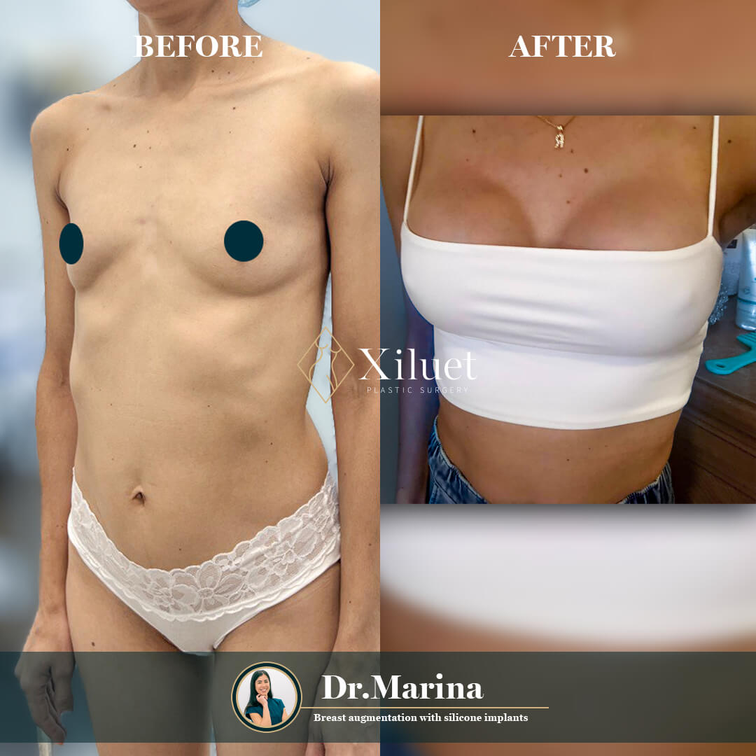 ¡Alerta de resultados asombrosos! Echa un vistazo a la impresionante transformación de nuestra hermosa paciente que se sometió a un aumento de senos (silicona), expertamente realizado por la Dra. Marina Zorrilla.