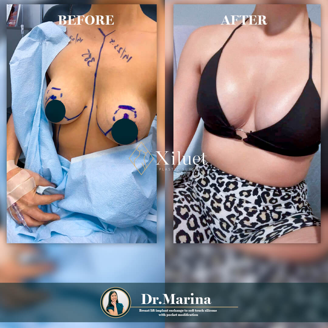¡Alerta de resultados asombrosos! Echa un vistazo a la impresionante transformación de nuestra hermosa paciente que se sometió a Levantamiento de Senos Implantes Intercambio Con Modificación Bolsillo, expertamente realizado por la Dra. Marina Zorrilla.