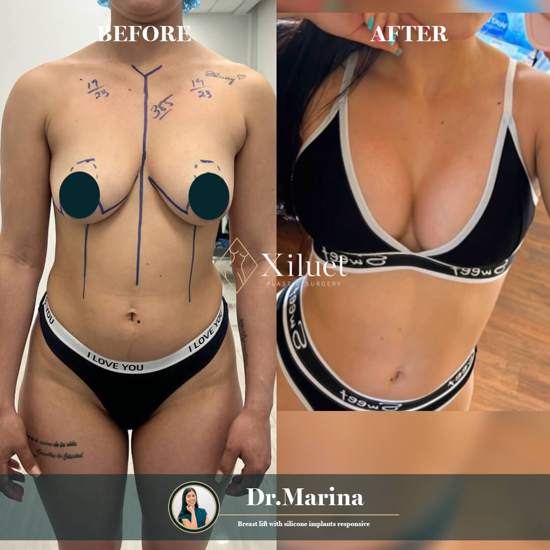 ¡Alerta de resultados asombrosos! Echa un vistazo a la impresionante transformación de nuestra hermosa paciente que se sometió a Levantamiento de Senos (Silicona), expertamente realizado por la Dra. Marina Zorrilla.