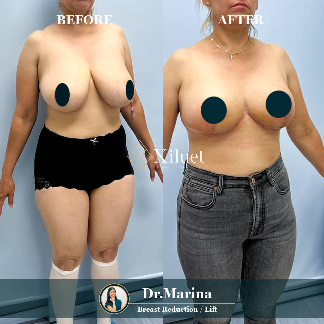 ¡Alerta de resultados asombrosos! Echa un vistazo a la impresionante transformación de nuestra hermosa paciente que se sometió a Reducción + Elevación de Mamas , expertamente realizado por la Dra. Marina Zorrilla.