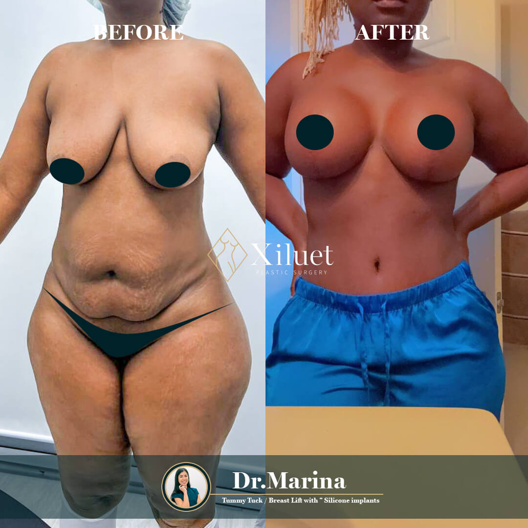 ¡Alerta de resultados asombrosos! Echa un vistazo a la impresionante transformación de nuestra hermosa paciente que se sometió a abdominoplastia + levantamiento de senos (silicona), expertamente realizado por la Dra. Marina Zorrilla.