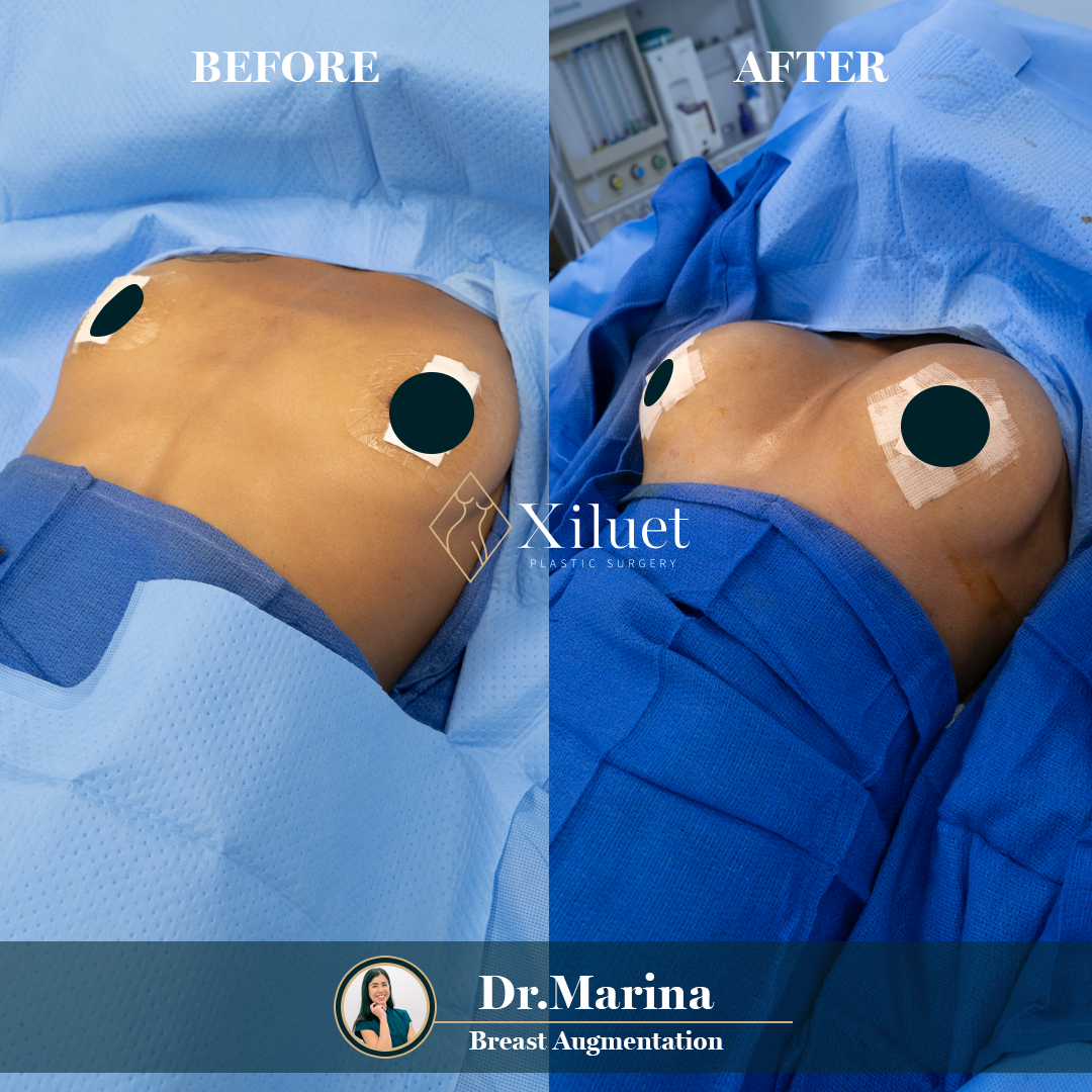 dr.marina-aumento-senos-11