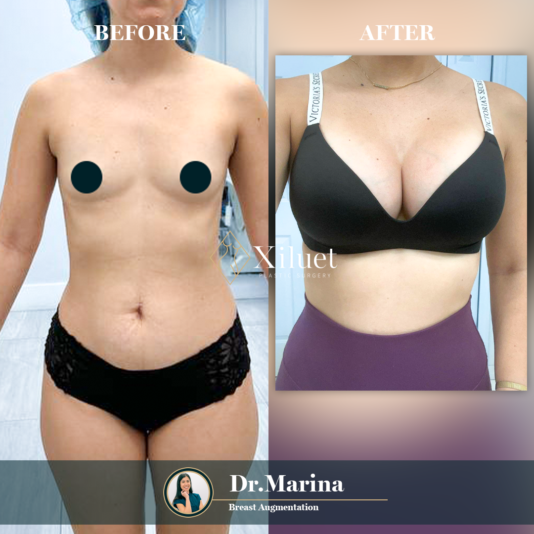 dr.marina-aumento-senos-12