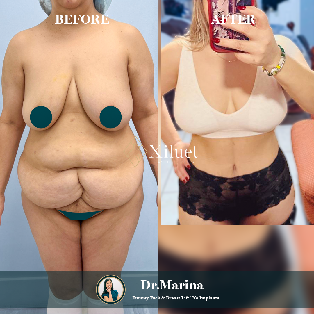 dr.marina-breast-lift-no-implantes