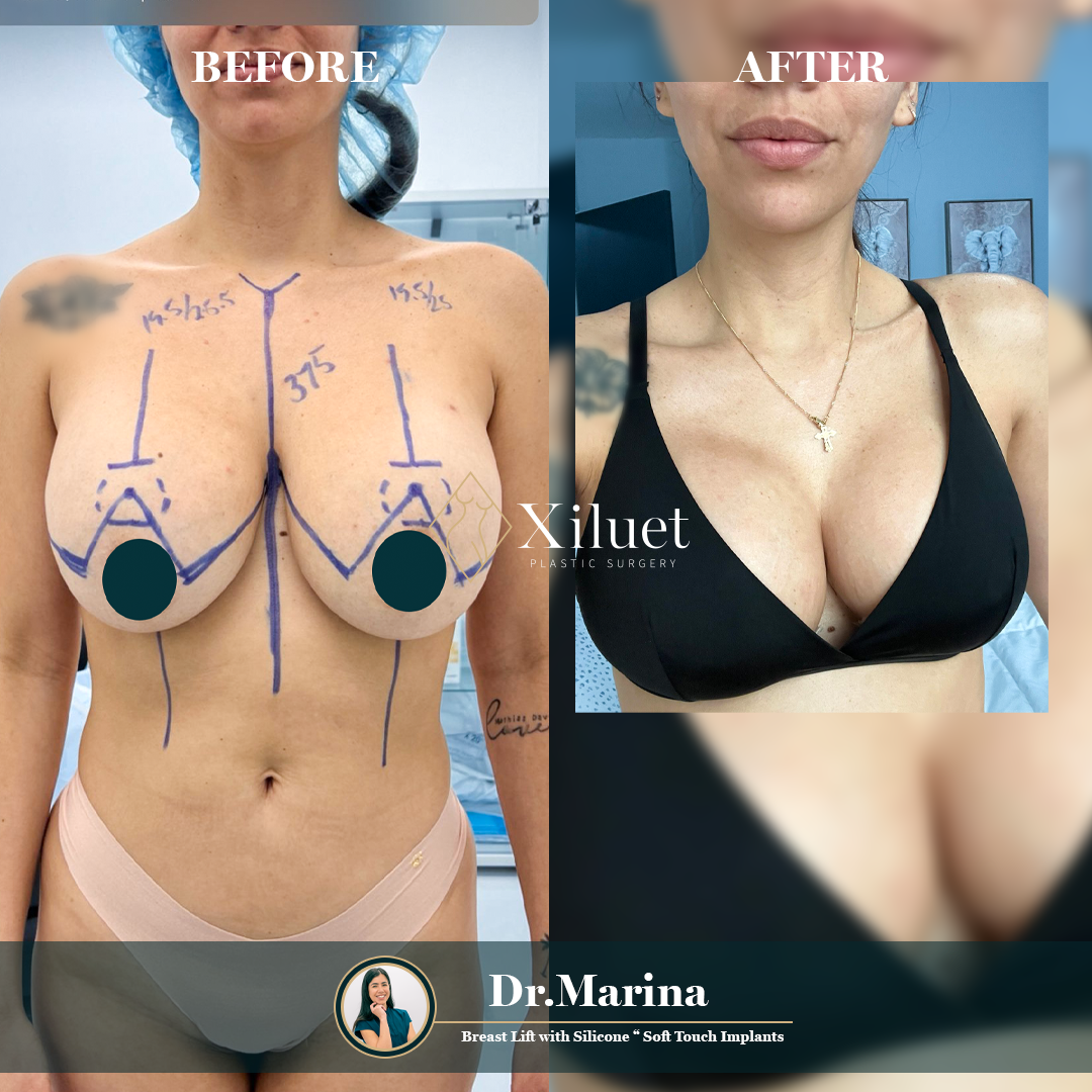 dr.marina-elevador-de-senos-soft-touch