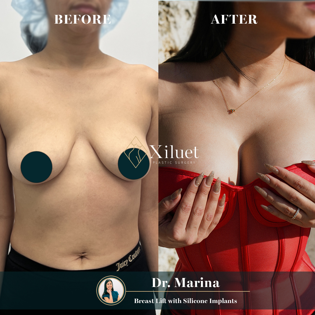 DR. Marina Elevación de mamas con implantes de silicona