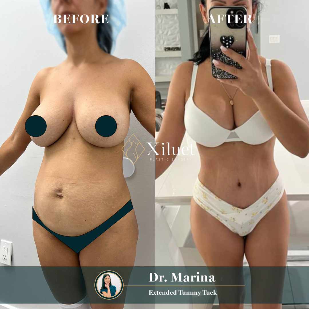 DR. Marina Abdominoplastia 1