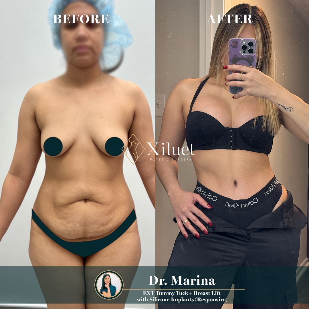 Marina Ext Abdominoplastia + Elevación de Mamas + Implantes de Silicona Responsive
